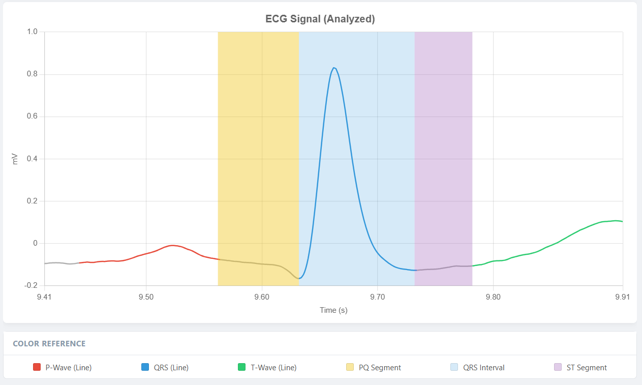 QRS Detection